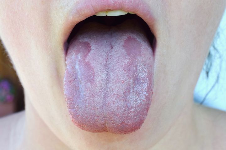 Candida Albicans może być przyczyną m.in. grzybicy jamy ustnej.