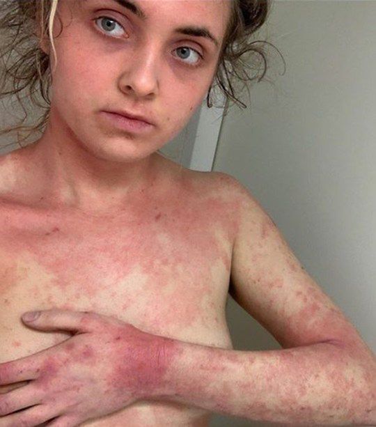  Dwa lata temu egzema zaczęła się pogarszać 