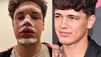 Polski influencer miał GROŹNY wypadek. "Skończyło się szwami i uszkodzonymi zębami"