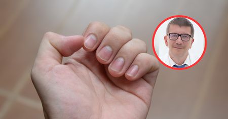 Tam może ukrywać się czerniak. Onkolog wskazuje, gdzie warto zajrzeć