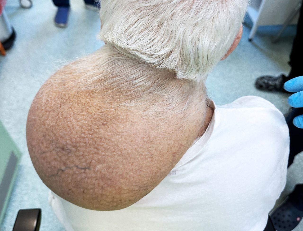 Lekarze usunęli gigantycznego guza z szyi pacjenta.