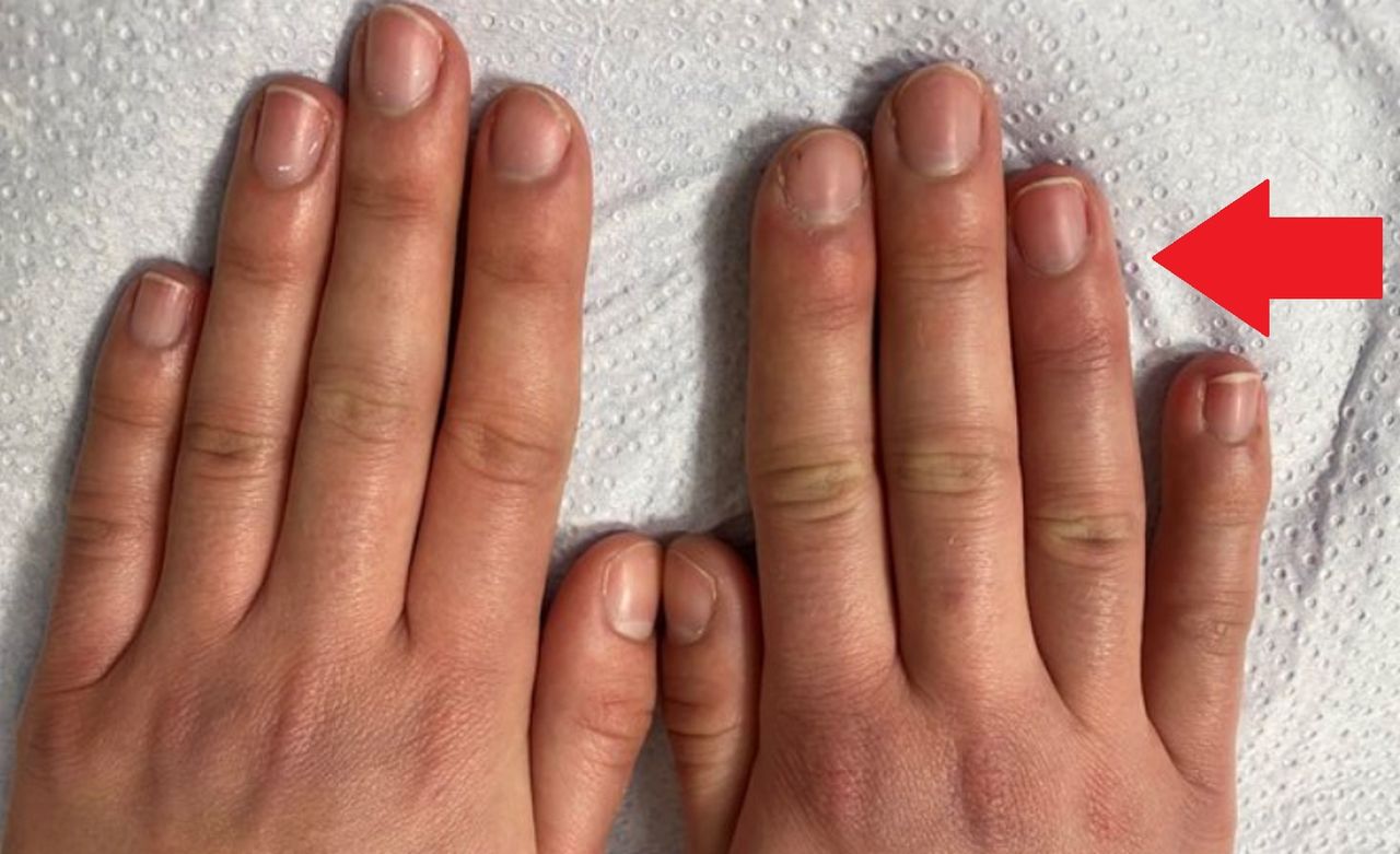 Lekarka pokazała, jak wyglądają "covidowe palce". Nastolatek trafił na SOR