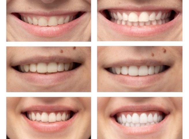 Efekty działania proszku do wybielania zębów Smilebite widać gołym okiem.