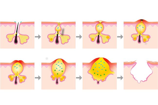Jak powstaje pryszcz?