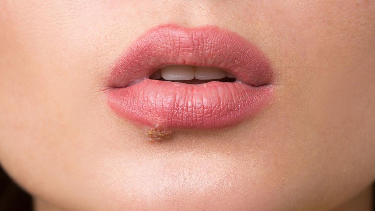 Opryszczka to choroba zakaźna, która ma tendencje do nawracania. 