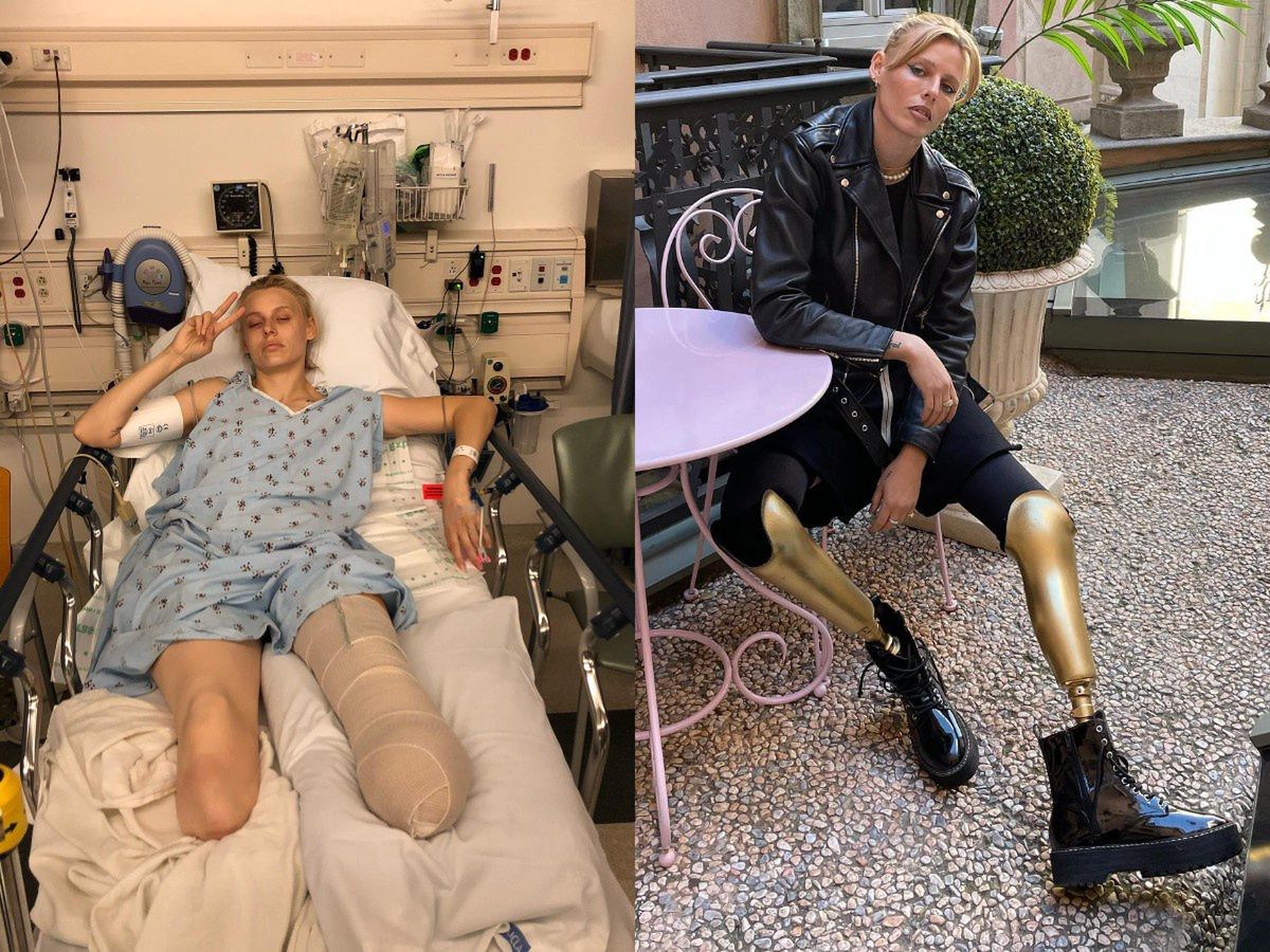 Modelka Lauren Wasser podzieliła się swoją trudną historią