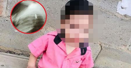Lekarze nie zdążyli jej wyciągnąć. Eksplodowała w przełyku 2-latka