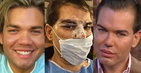 "Żywy Ken" o uzależnieniu od operacji plastycznych: "Kończę z tym! Wykonam tylko w nagłym wypadku!"