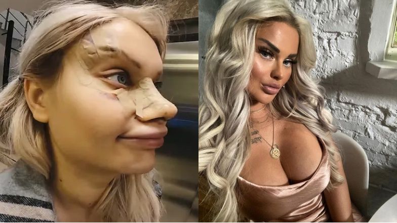 Ewelina wspomina operacje w Turcji: "Byłam bardzo zadowolona"