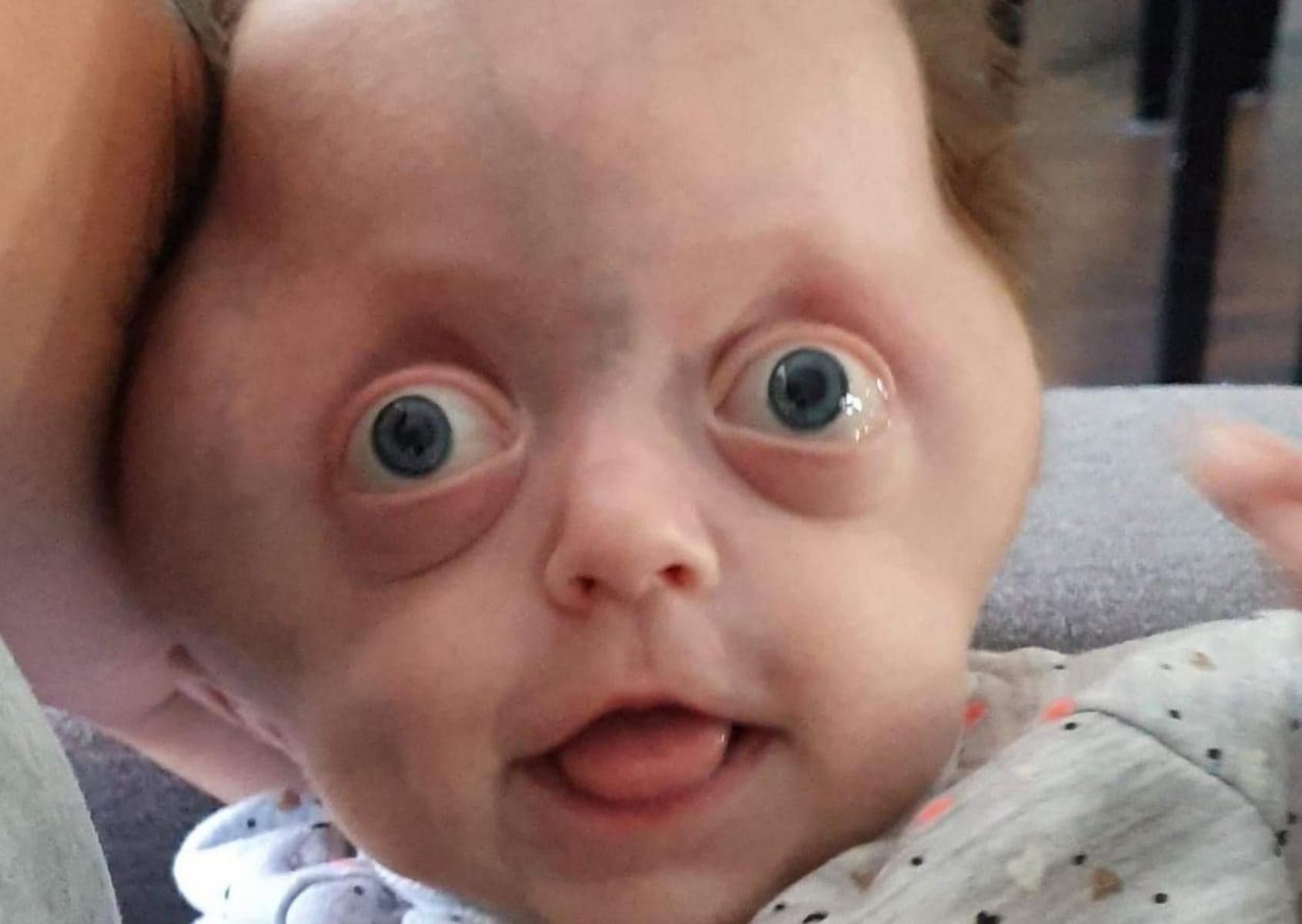 6-miesięczna Hania cierpi na rzadką chorobę Crouzona/ Pfeiffera