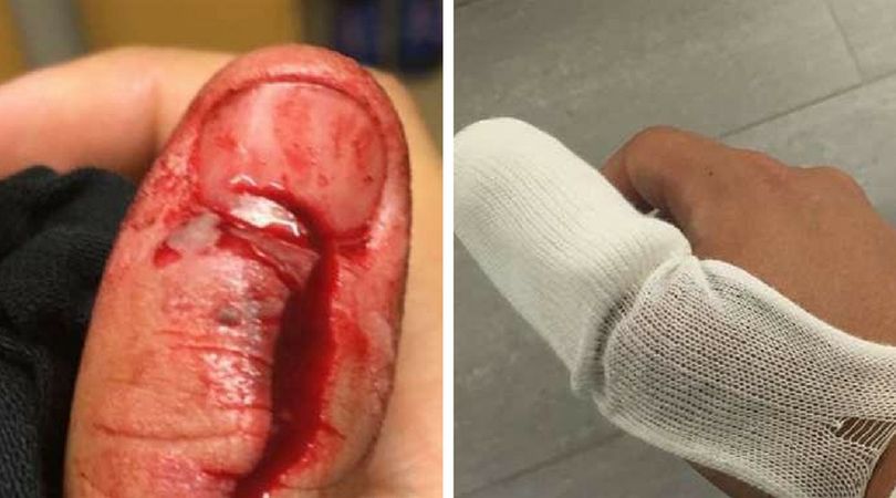 Niebezpieczny fidget spinner - złamał kość i naderwał ścięgna