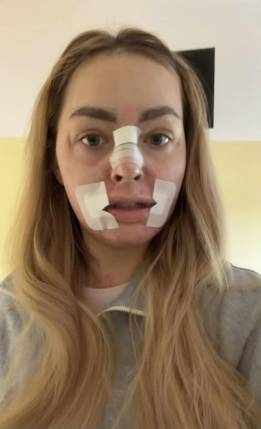 Tiktokerka, która płonęła żywcem, przeszła kolejną operację