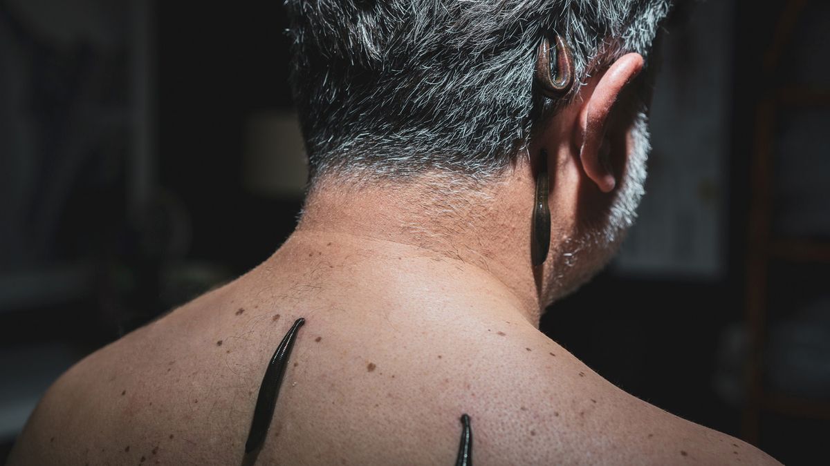 Pijawki wracają do łask