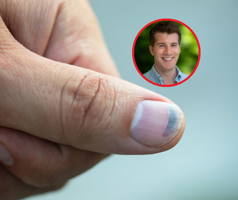 Chore serce zobaczysz na paznokciach. Lekarz ostrzega przed mało znanym objawem