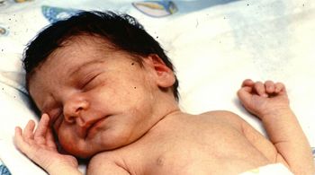 12-dniowemu dziecku wszczepili serce pawiana. Historia, która porusza