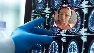 Myślała, że pogarsza się jej wzrok. Tak objawiał się guz mózgu