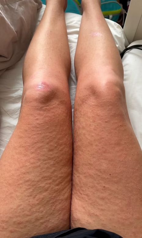 U 27-latki pojawiły się też swędzące guzki