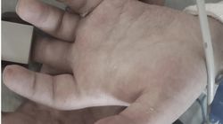 Sine dłonie mogą być objawem COVID-19