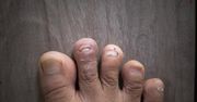 Objaw wysokiego cholesterolu, który dostrzeżesz na paznokciach stóp