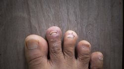 Objaw wysokiego cholesterolu, który dostrzeżesz na paznokciach stóp