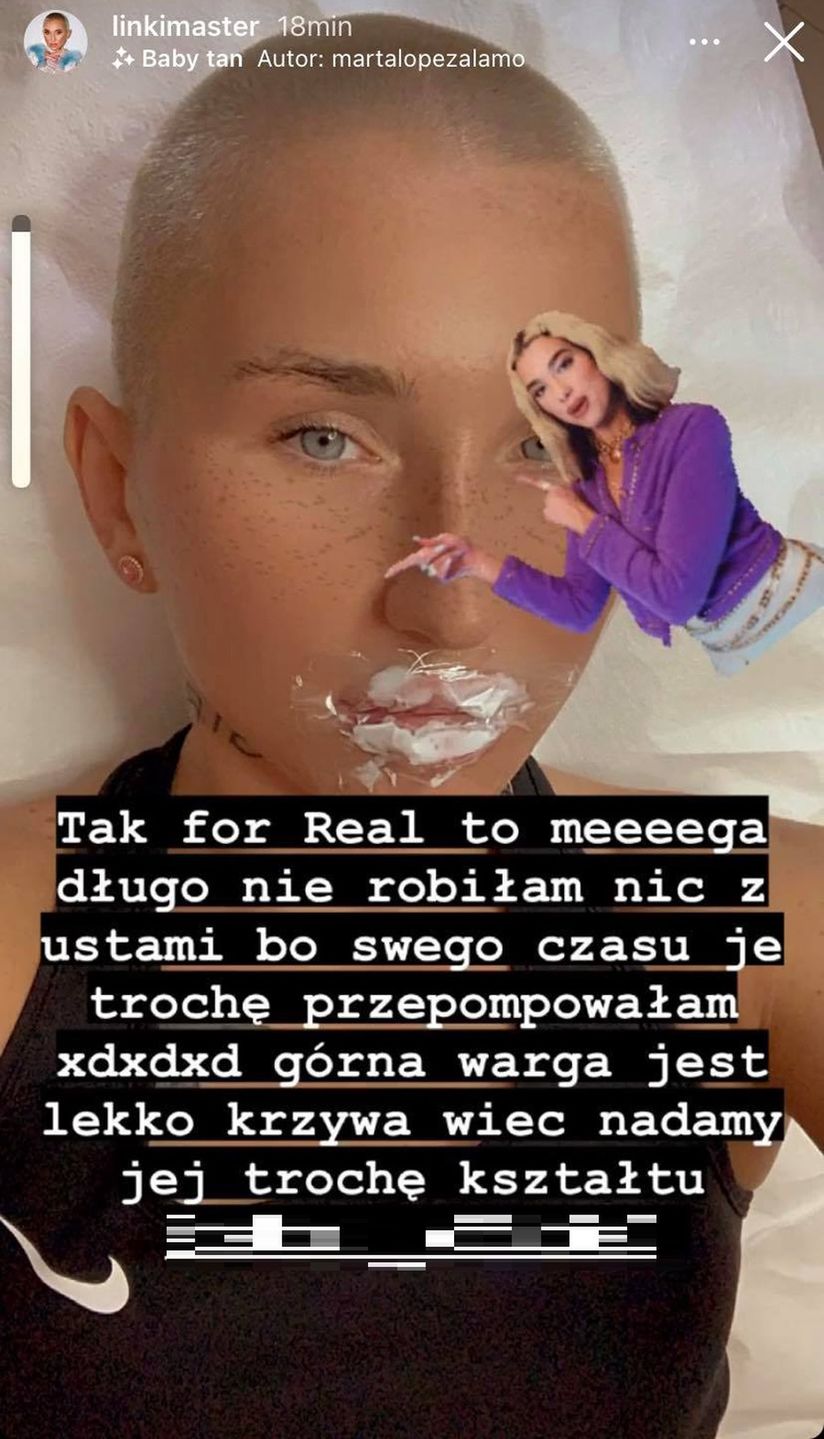 Marta Linkiewicz na zabiegu powiększania ust