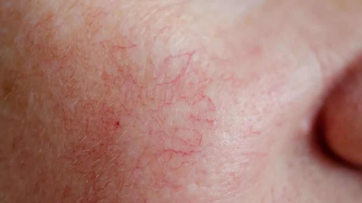 Jak zamaskować naczynka? 