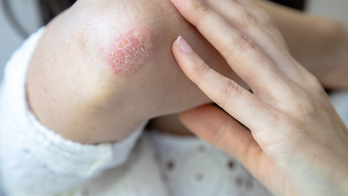 Sucha skóra na łokciach. Jak pozbyć się problemu?