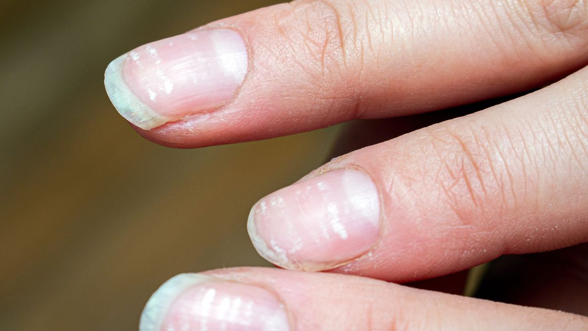 vitamin deficiency avitaminosis anemia nail problem with white dotsvitamin deficiency avitaminosis anemia nail problem with white dotsVitalii Bezverkhiihardener, leukonychia, avitaminosis
