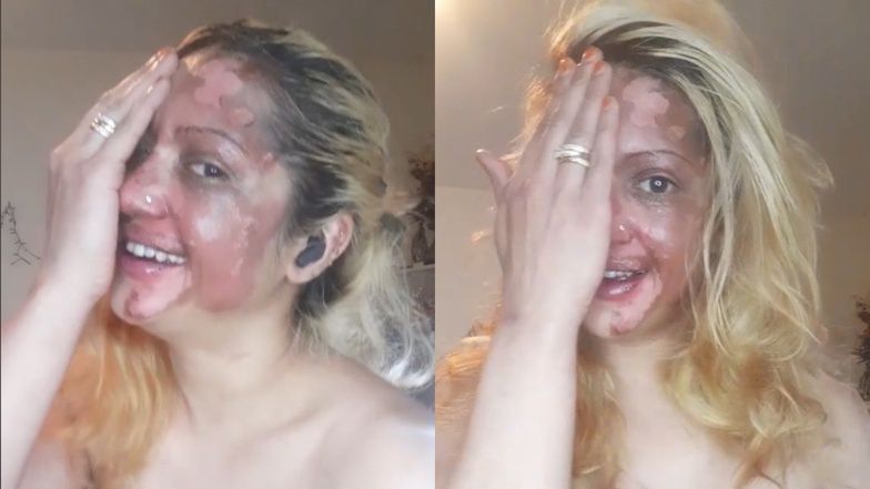TikTokerka chciała wypróbować nowy trend. Teraz ma poparzoną twarz
