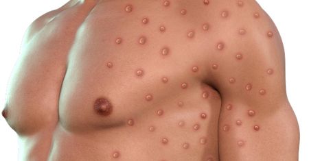 Małpia ospa znów groźna. Mpox błyskawicznie rozprzestrzenia się w Afryce i dociera do USA