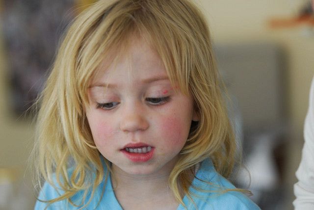 Wszawica u dzieci to infekcja wywoływana przez wszy głowowe. 