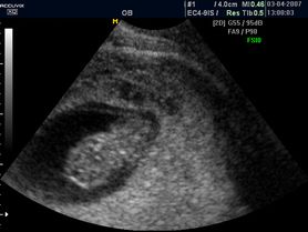 Płód w 9 tygodniu ciąży (zdjęcia)