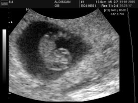 Płód w 8 tygodniu ciąży (zdjęcia)