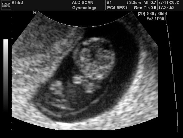 Płód w 9 tygodniu ciąży - widok główki dziecka 