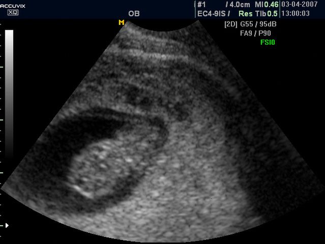 Płód w 9 tygodniu ciąży - obraz USG 