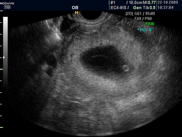 Płód w 8 tygodniu ciąży - obraz USG 