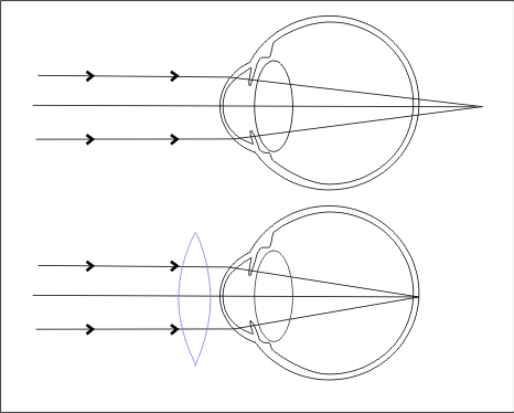 Rysunki obrazujące to jak widzą osoby z dalekowzrocznością 