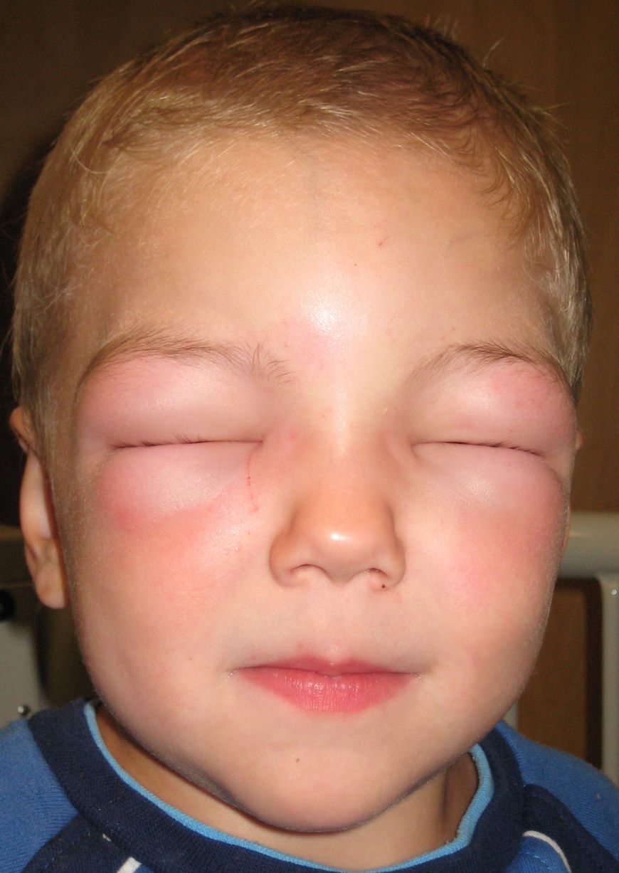Opuchnięta twarz dziecka w wyniku obrzęku Quinckego
