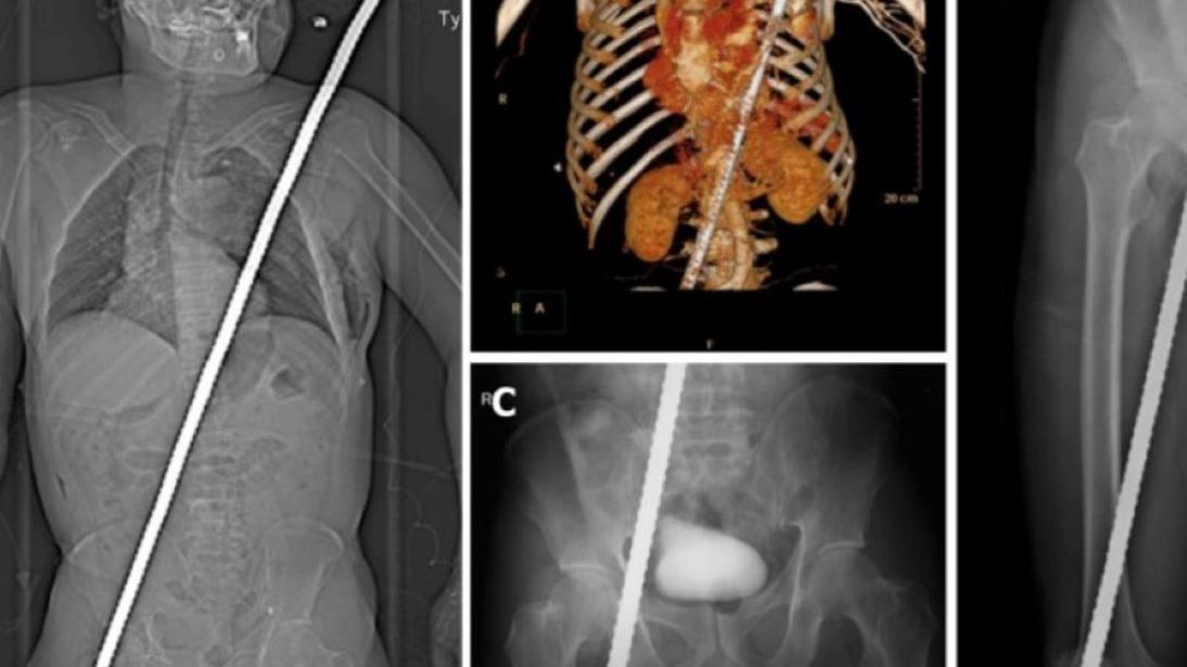 Pacjent został przebity na wylot prętem zbrojeniowy 