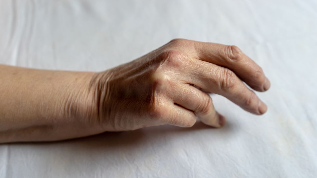 Przykurcz Dupuytrena początkowo charakteryzuje się pojawieniem drobnych guzków