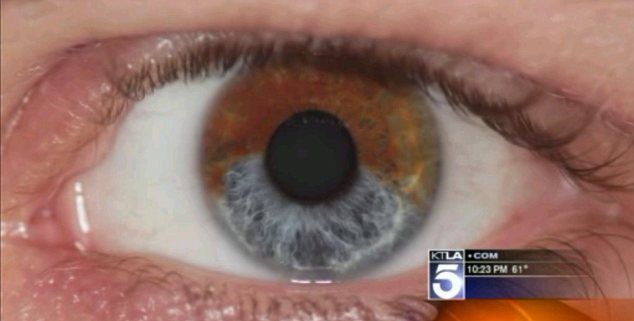 Laser, który pozwala na stałe zmienić kolor oczu