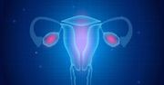 Zespół policystycznych jajników (PCOS) - przyczyny, objawy, leczenie