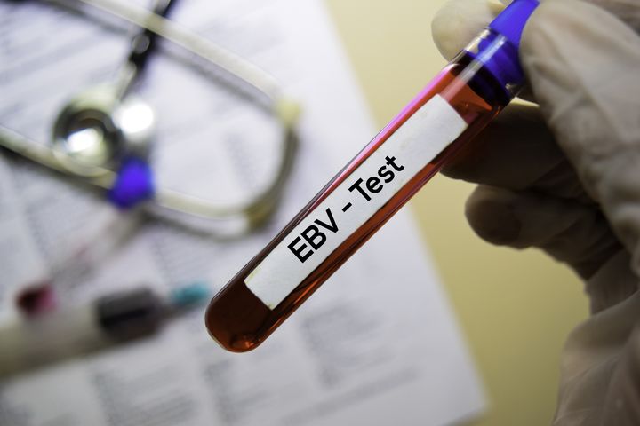 Wirus EBV (wirus Epsteina-Barr) występuje dość powszechnie w naszej populacji. Szacuje się, że zarażonych może być nawet 80% osób powyżej 40. roku życia lub starszych.