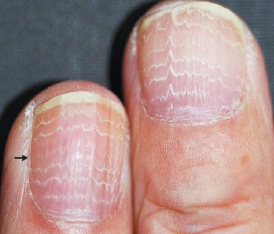 Zmiany na paznokciach mogą być reakcją na chemioterapię