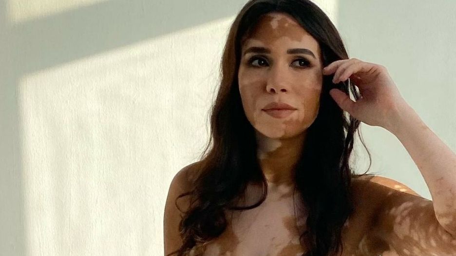Wygl?da jak Meghan Markle z bielactwemReham only gathered the courage to accept her vitiligo six years ago. DUBAI, UNITED ARAB EMIRATES: MODEL turns the tables on trolls her called her a cow by being likened to Megan Markle with vitiligo. Vitiligo advocate Reham Soliman (34) from Cairo, Egypt was diagnosed with vitiligo at 14-years-old. Reham?s vitiligo started with a dot on her neck and spread to over 60% of her body. Growing up she was bullied for her skin condition and grew to resent it, feeling unconscious of her skin. Reham?s vitiligo held her back from many social occasions and tainted the happy moments of her life. She was bullied in school for her skin condition making her more conscious of her look. Reham only gathered the courage to accept her vitiligo six years ago, she reached a point where she was so disappointed, stressed and tired she gave up on caring what others thought of her. She decided to be herself in all respect and gained a newfound confidence. Reham has pleasantly surprised when she was approached by a modelling agency in 2020, which wanted to feature her in a skincare brand. She had not expected that at all, even though she has been told she looks like Meghan Markle with vitiligo. mediadrumimages.com/@rehamsolimansmediadrumimages.com/@rehamsolima