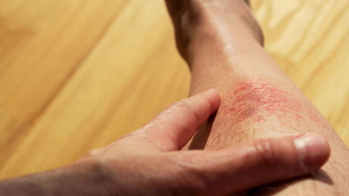 Łuszczyca jako jeden z objawów IBD