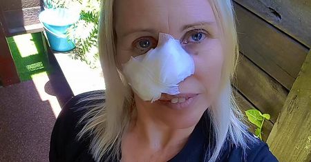 Guzek na nosie okazał się być rakiem. Kobieta niemalże przeoczyła chorobę