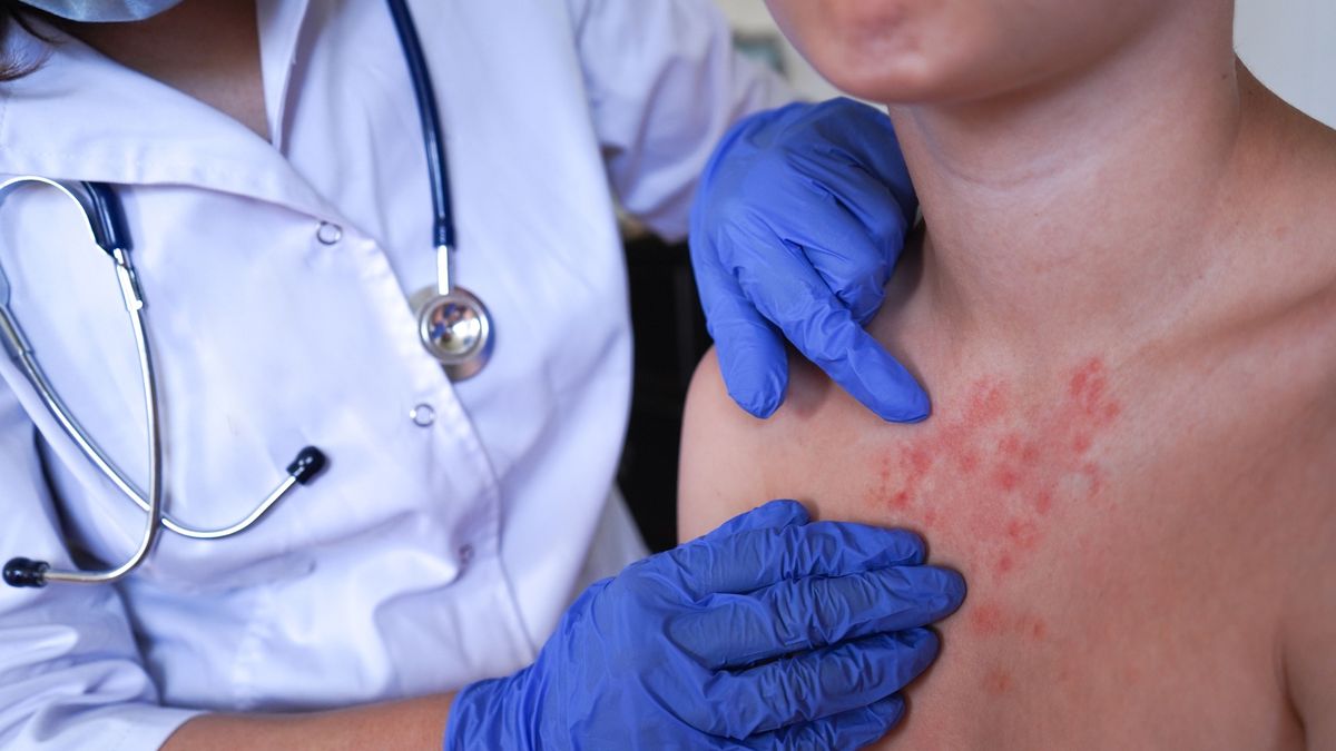 Rzadkie, ale śmiertelne powikłanie odry