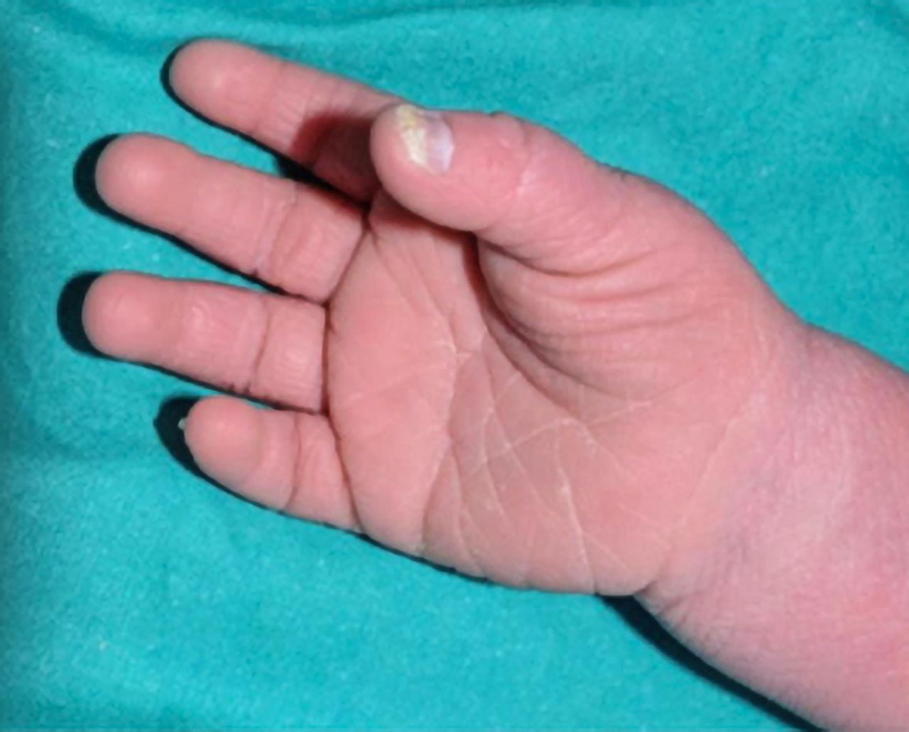 Ta nieuleczalna choroba zwana jest "rybią łuską". U niemowląt może objawić się niedowagą