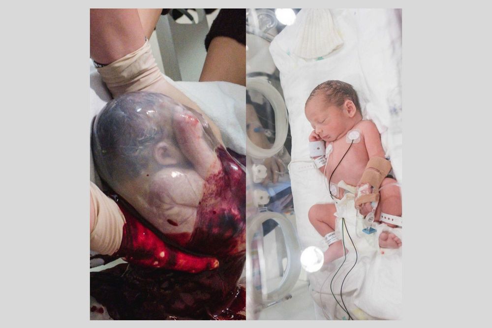 Noworodek w worku owodniowym